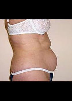 Liposuction Case 11