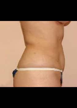 Liposuction Case 12