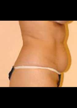 Liposuction Case 12