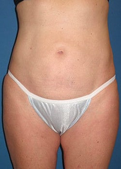 Liposuction Case 14