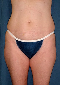 Liposuction Case 14