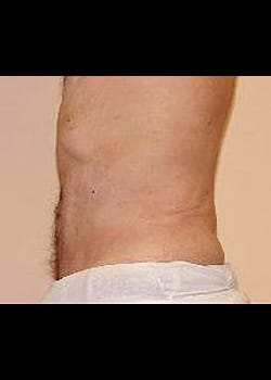 Liposuction Case 15