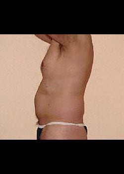 Liposuction Case 15