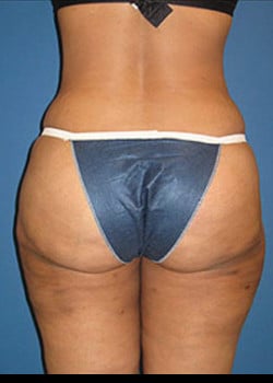 Liposuction Case 18