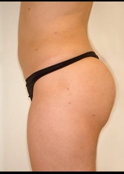 Liposuction Case 20