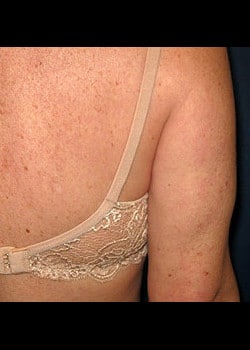 Liposuction Case 21