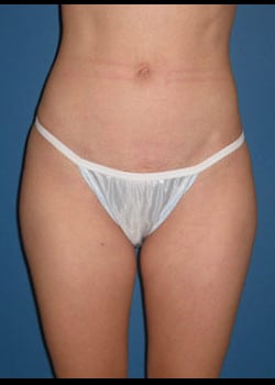 Liposuction Case 22