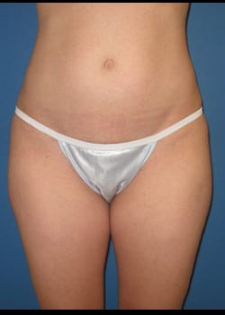 Liposuction Case 22