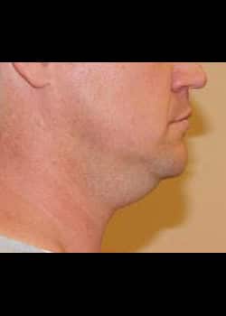 Liposuction Case 23