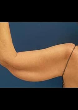 Liposuction Case 27