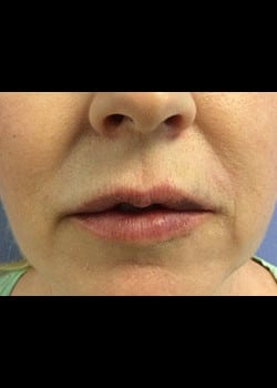 Restylane Case 10