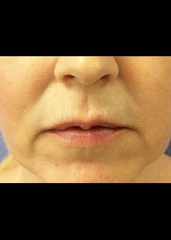 Restylane Case 10