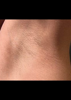 Laser Hair Removal Case 2
