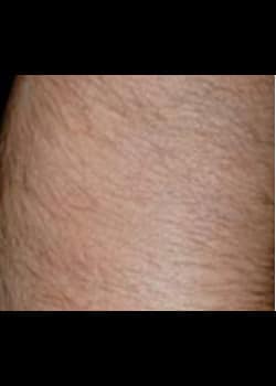 Laser Hair Removal Case 5