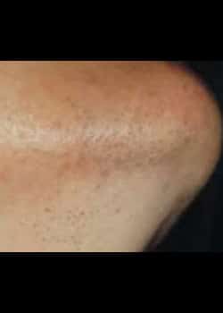 Laser Hair Removal Case 6