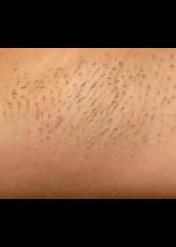 Laser Hair Removal Case 11