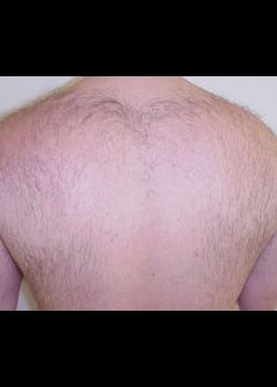 Laser Hair Removal Case 12