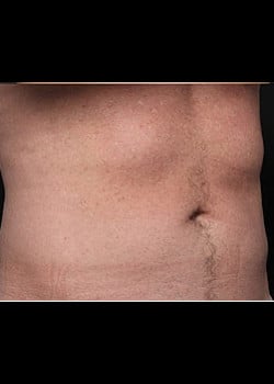 CoolSculpting Case 14