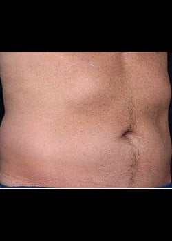 CoolSculpting Case 14