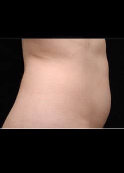 CoolSculpting Case 16