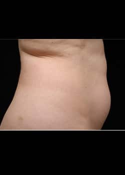 CoolSculpting Case 16