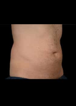 CoolSculpting Case 17