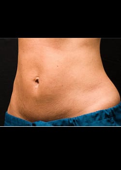 CoolSculpting Case 18