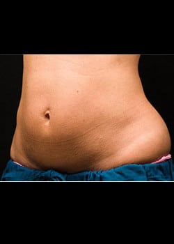 CoolSculpting Case 18