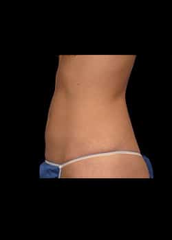 CoolSculpting Case 19