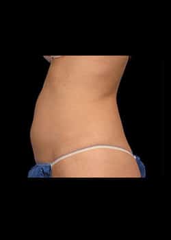 CoolSculpting Case 19