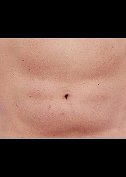 CoolSculpting Case 20