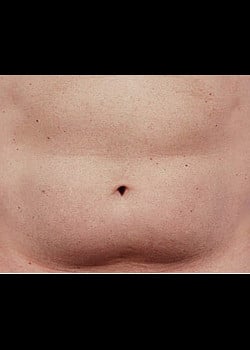 CoolSculpting Case 20