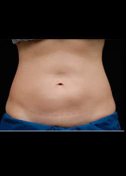 CoolSculpting Case 21