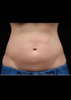 CoolSculpting Case 21