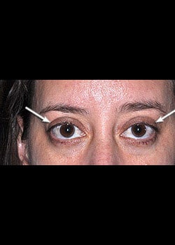 Eyelid Rejuvenation Case 4