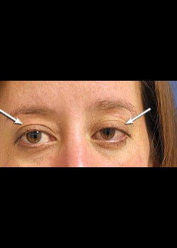 Eyelid Rejuvenation Case 4