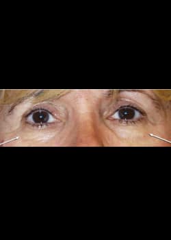 Eyelid Rejuvenation Case 5