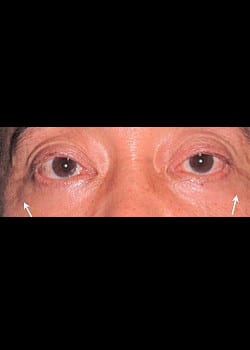 Eyelid Rejuvenation Case 6