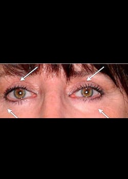 Eyelid Rejuvenation Case 7