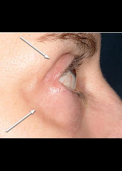 Eyelid Rejuvenation Case 8