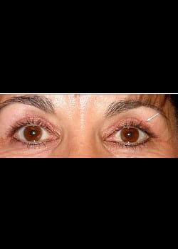 Eyelid Rejuvenation Case 9