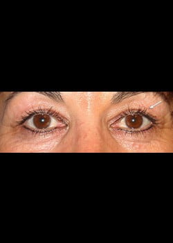 Eyelid Rejuvenation Case 9