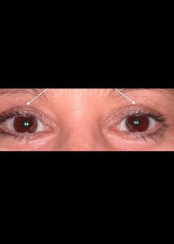 Eyelid Rejuvenation Case 10