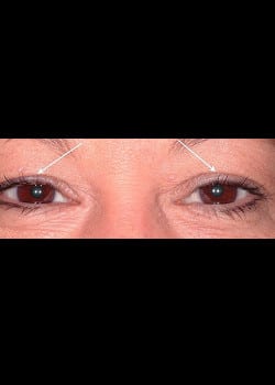 Eyelid Rejuvenation Case 10