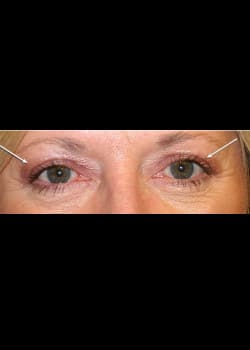 Eyelid Rejuvenation Case 11