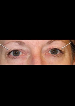 Eyelid Rejuvenation Case 11