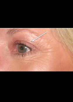 Eyelid Rejuvenation Case 12