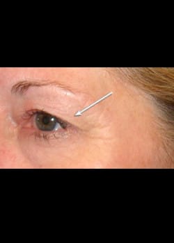 Eyelid Rejuvenation Case 12