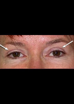 Eyelid Rejuvenation Case 13