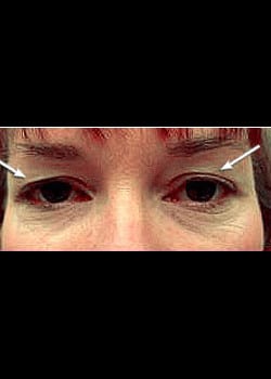 Eyelid Rejuvenation Case 13